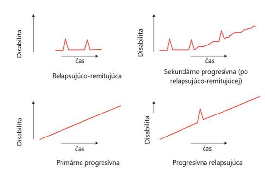Formy klinického priebehu SM